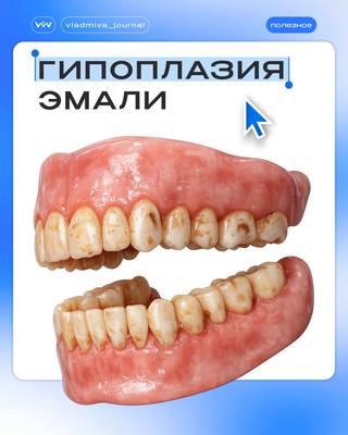 Гипоплазия эмали: белые пятна, которые не лечатся отбеливанием.